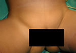Hernias may often be subtle, and can appear as swellings in the groin
