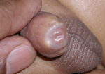 Very often, beads of smegma (whitish, pasty material) accumulate under the adherent foreskin. These may be normal